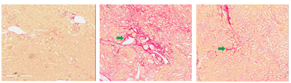 Unilateral Ureteral Obstruction (UUO) renal kidney fibrosis and tubular injury model, Sirius red staining 