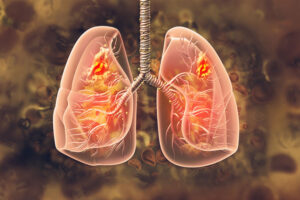 Respiratory disorders, lung, asthma